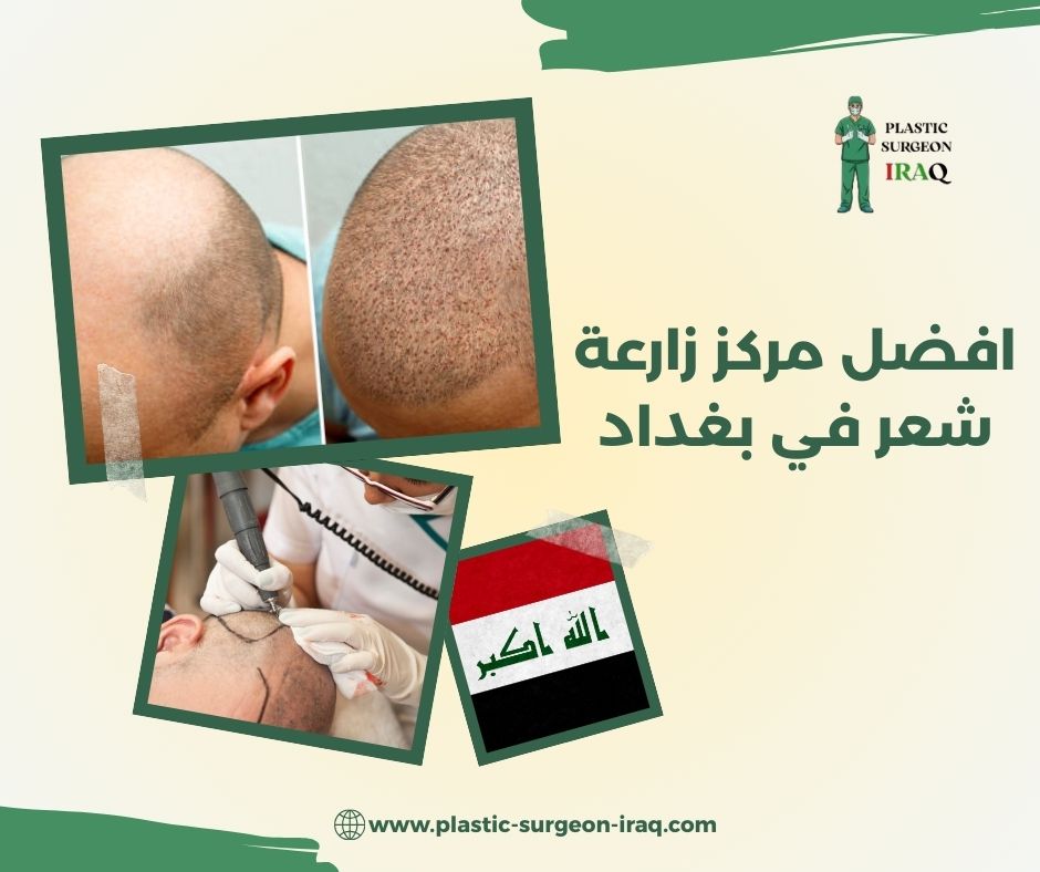 افضل مركز زارعة شعر في بغداد