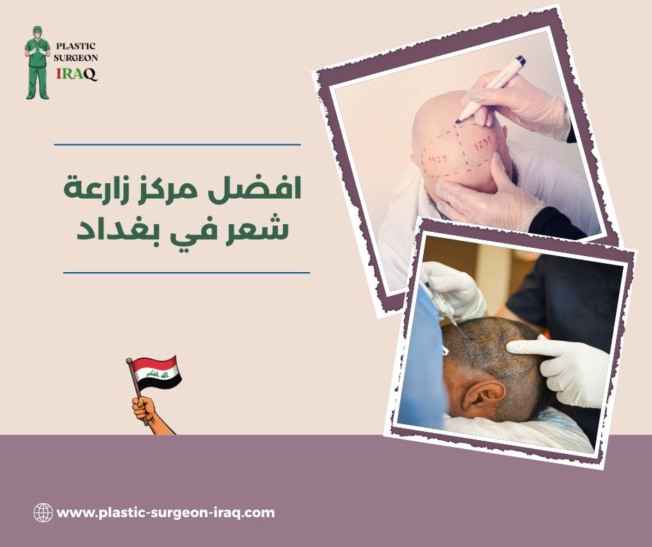افضل مركز زارعة الشعر في العراق