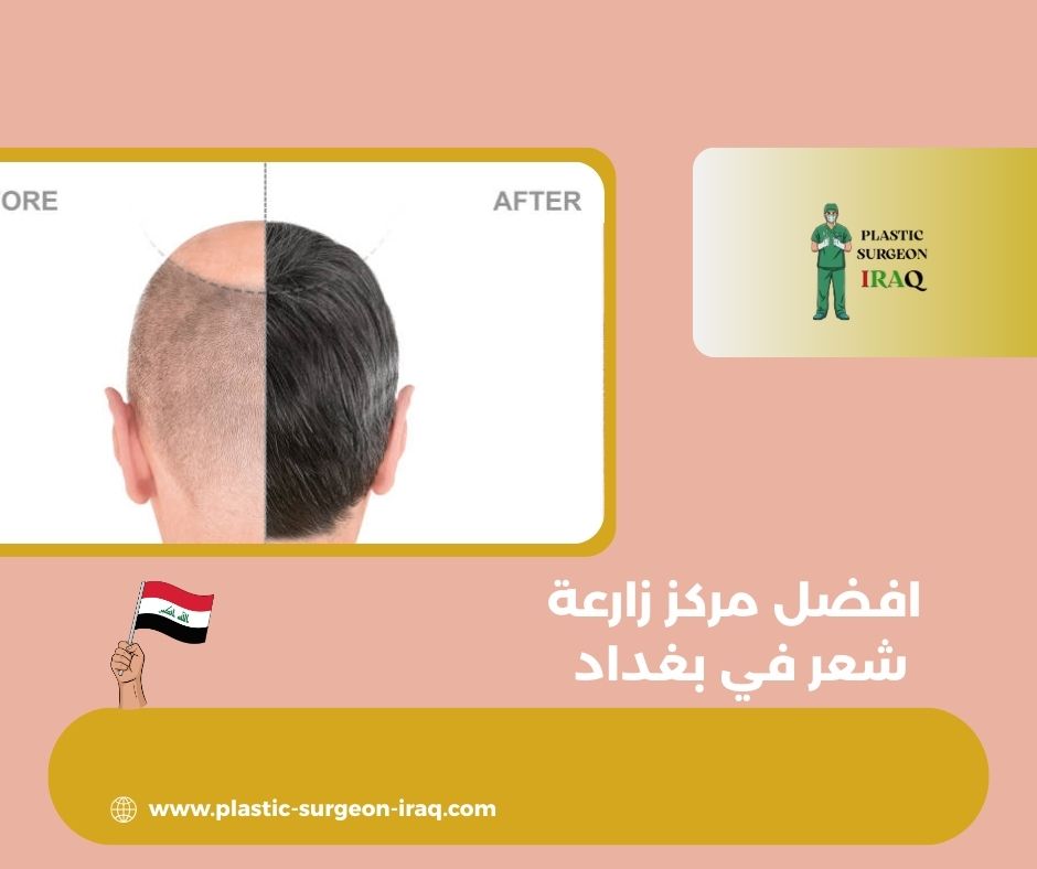افضل مركز زارعة الشعر في بغداد