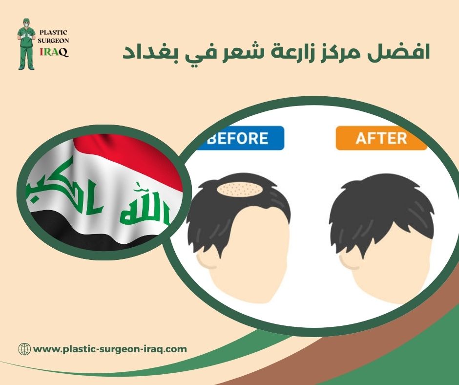 احسن مركز زراعة شعر في بغداد
