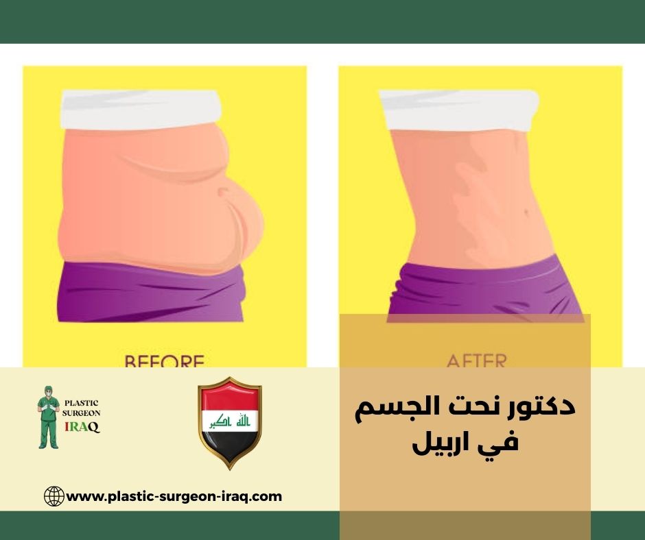 دكتور نحت الجسم في اربيل