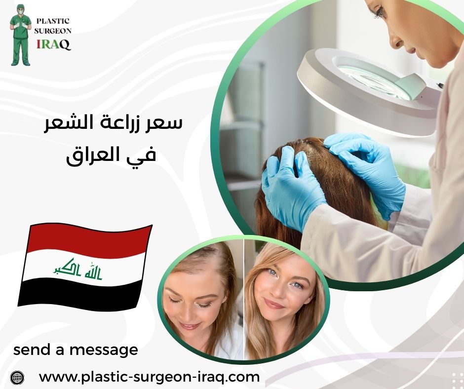 سعر زراعة الشعر في العراق