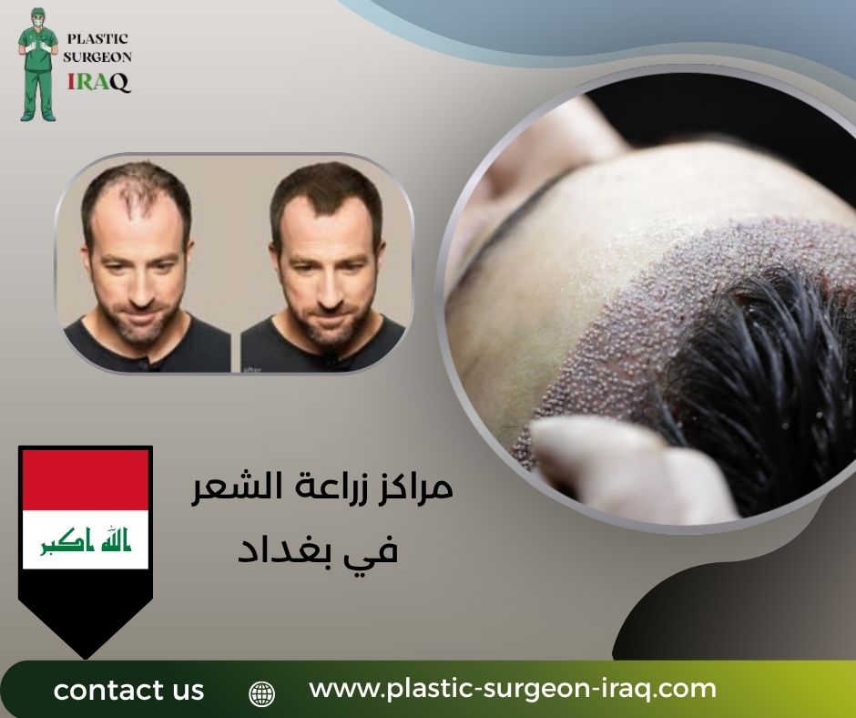 مراكز زراعة الشعر في بغداد