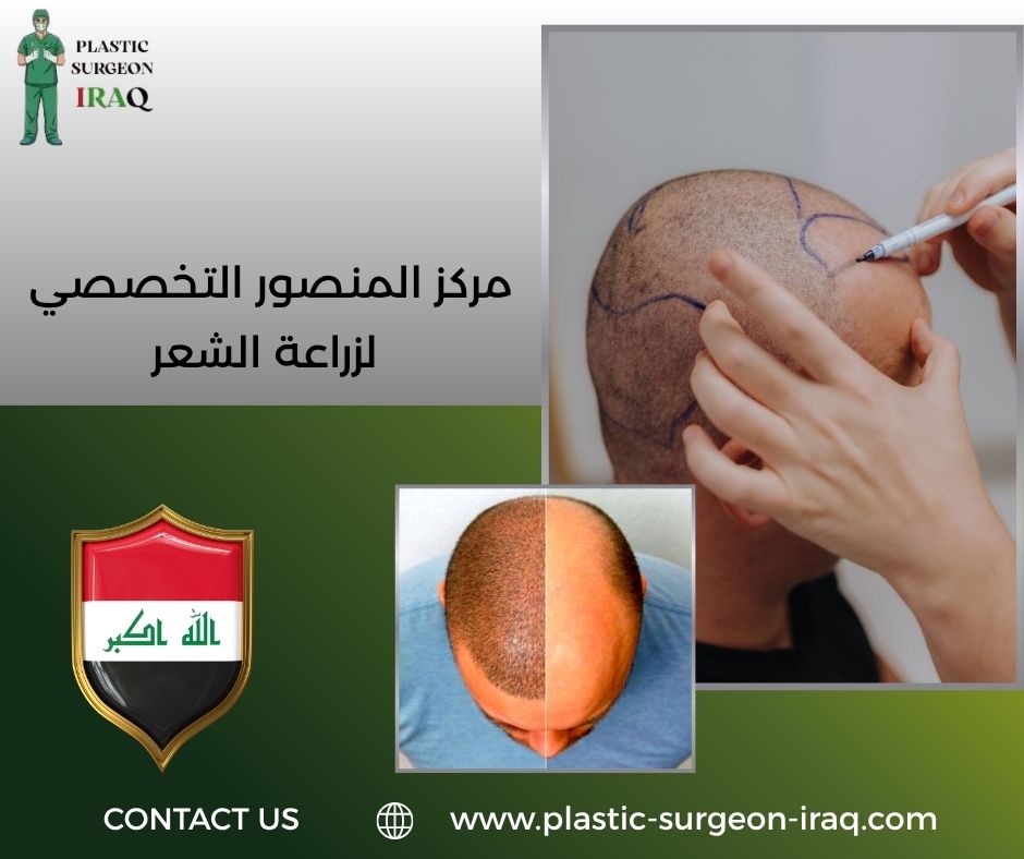 مركز المنصور التخصصي لزراعة الشعر