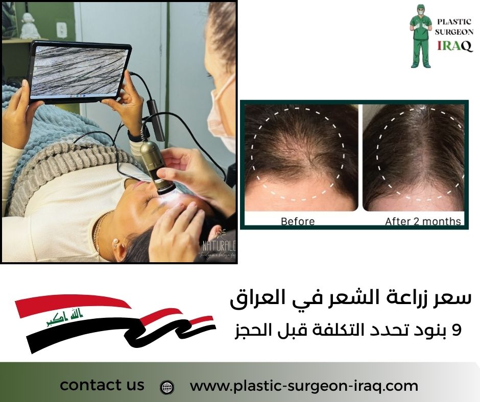 سعر زراعة الشعر في العراق