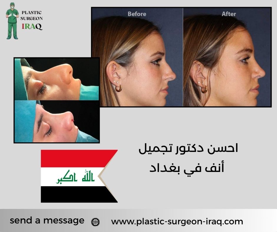احسن دكتور تجميل أنف في بغداد