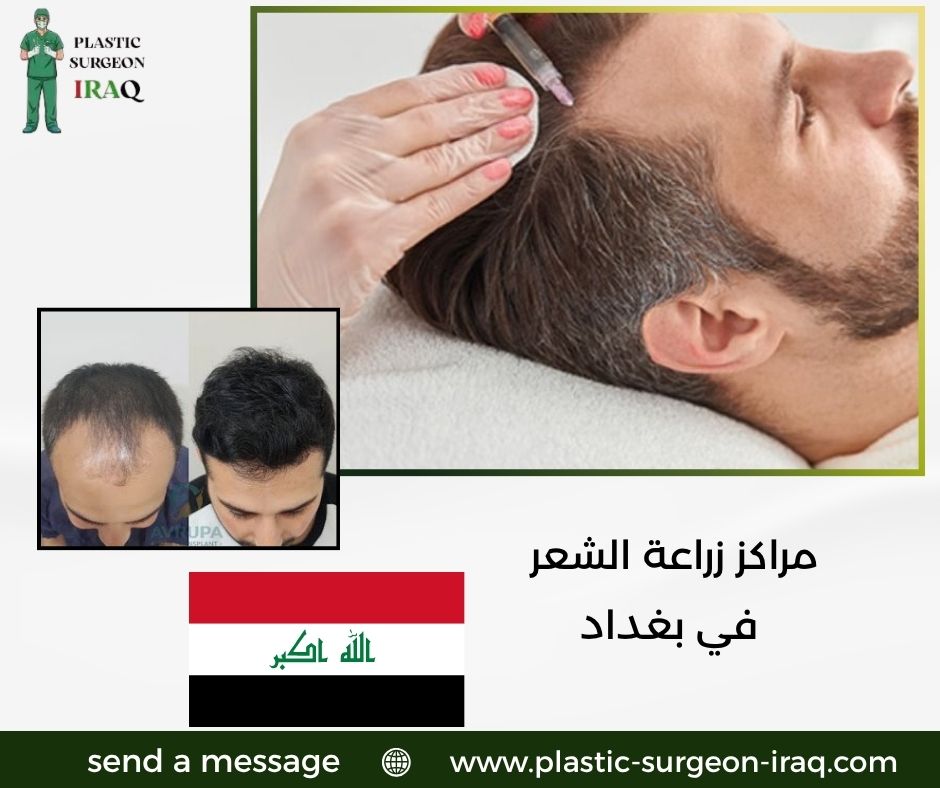مراكز زراعة الشعر في بغداد