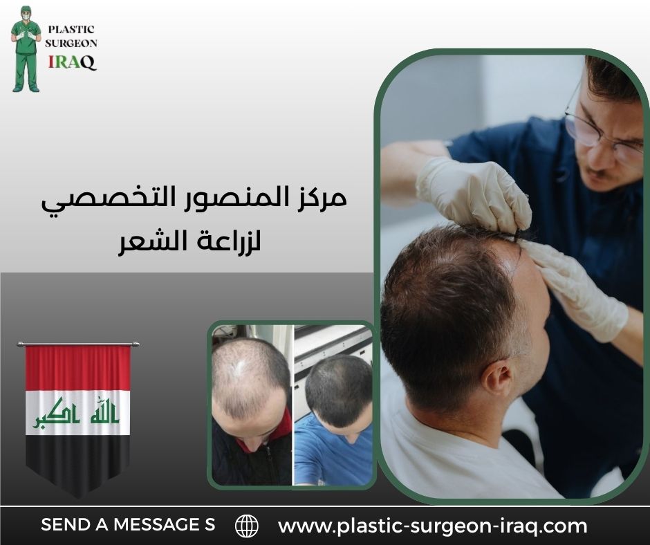 مركز المنصور التخصصي لزراعة الشعر