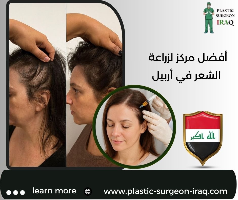 أفضل مركز لزراعة الشعر في أربيل