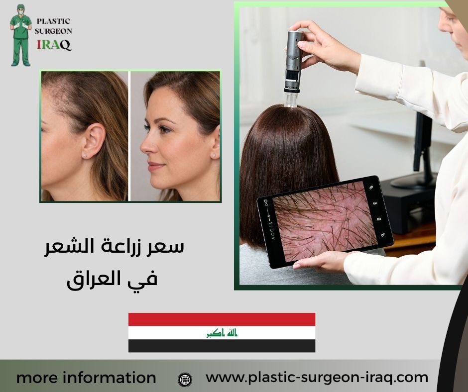 سعر زراعة الشعر في العراق