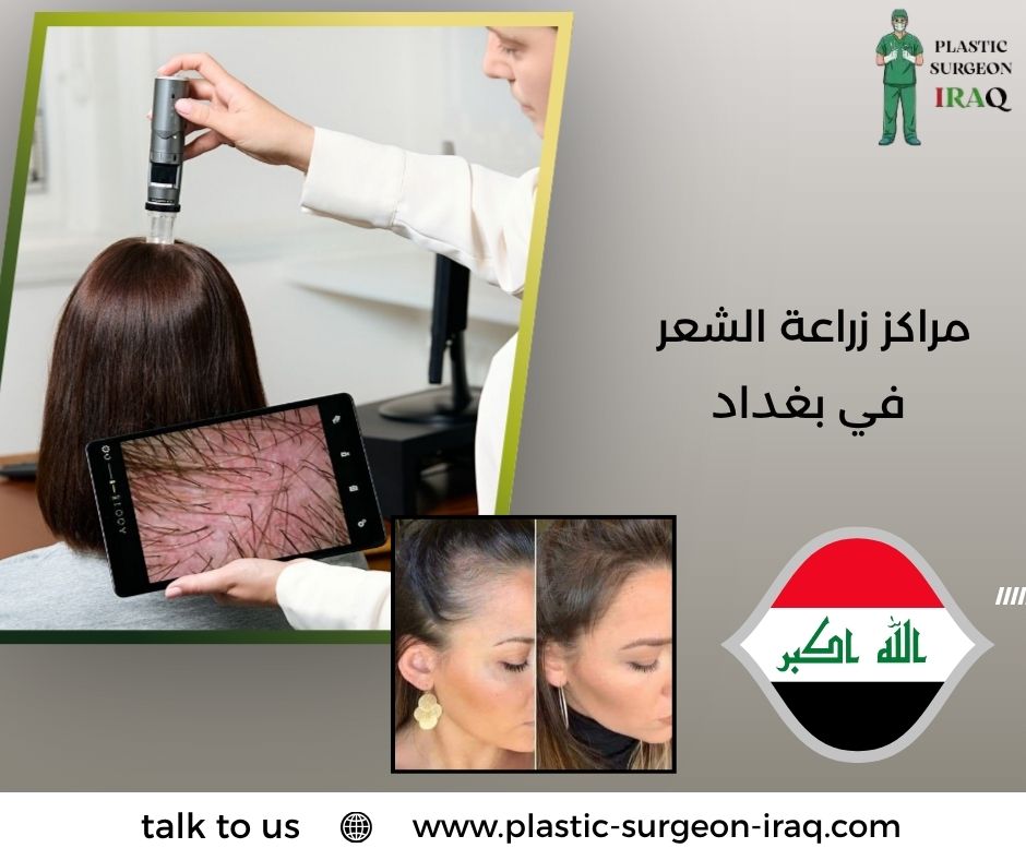 مراكز زراعة الشعر في بغداد