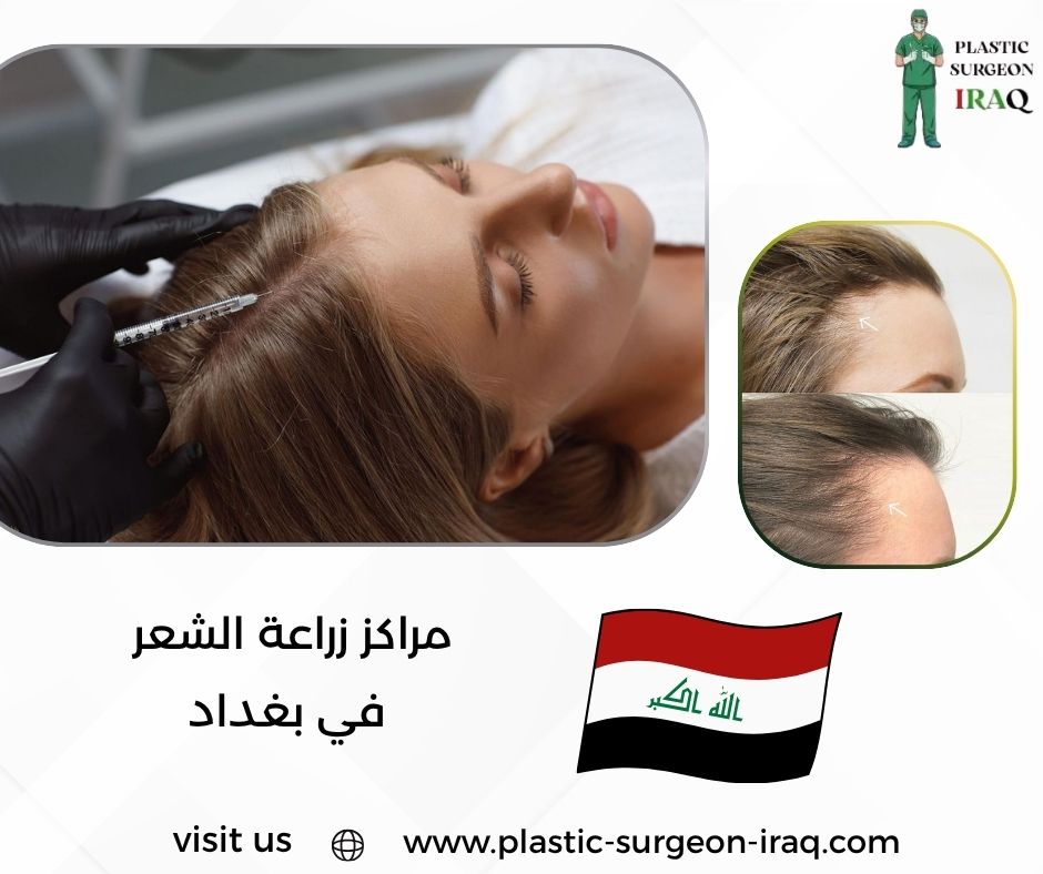 مراكز زراعة الشعر في بغداد