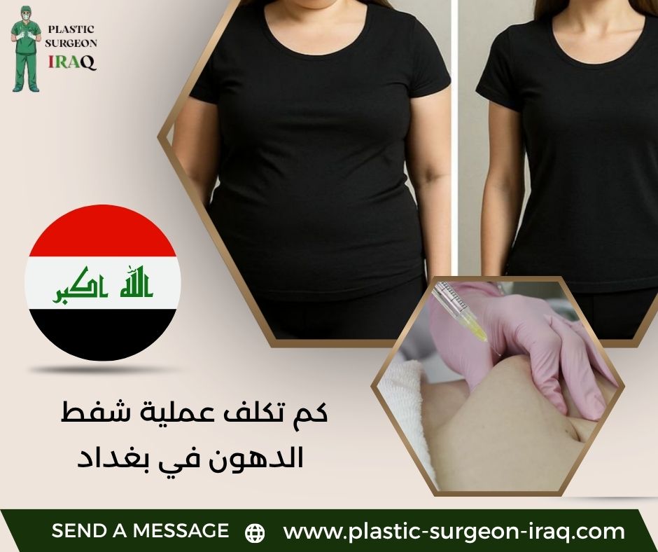 كم تكلف عملية شفط الدهون في بغداد