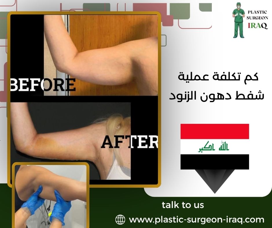 كم تكلفة عملية شفط دهون الزنود