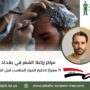 مراكز زراعة الشعر في بغداد