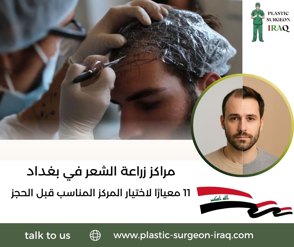 مراكز زراعة الشعر في بغداد