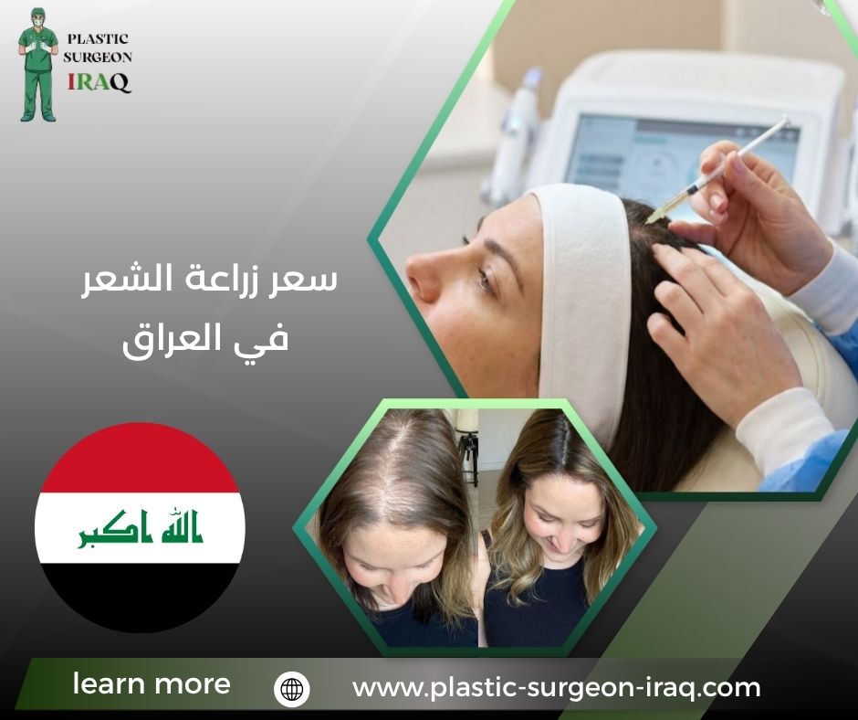 سعر زراعة الشعر في العراق