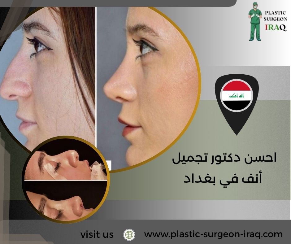 احسن دكتور تجميل أنف في بغداد