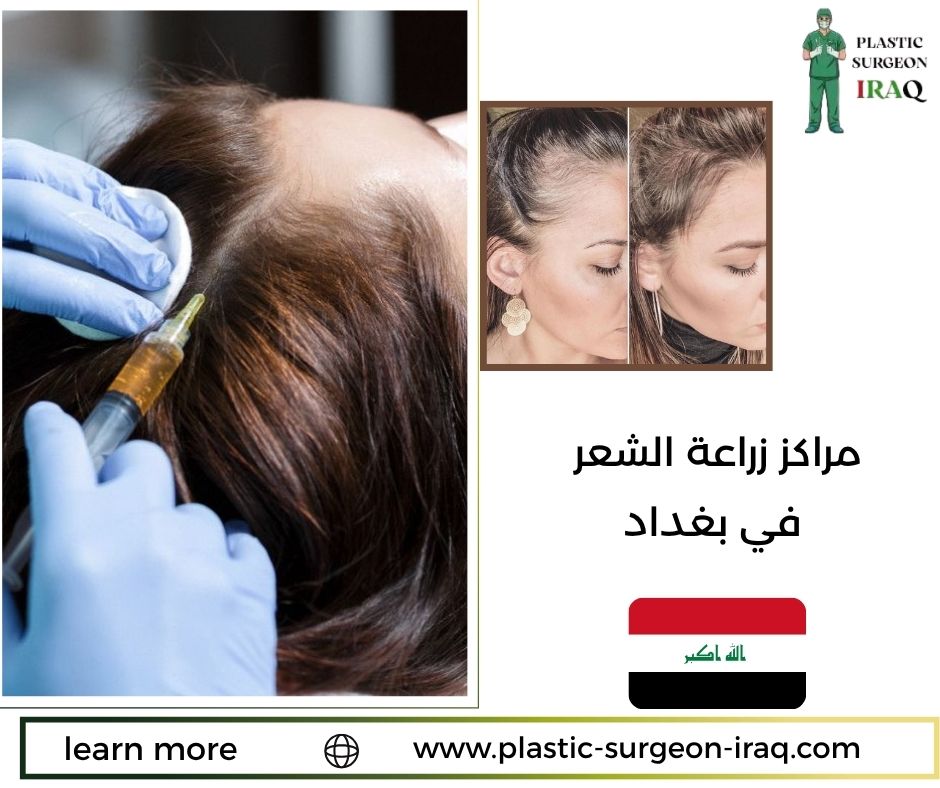 مراكز زراعة الشعر في بغداد