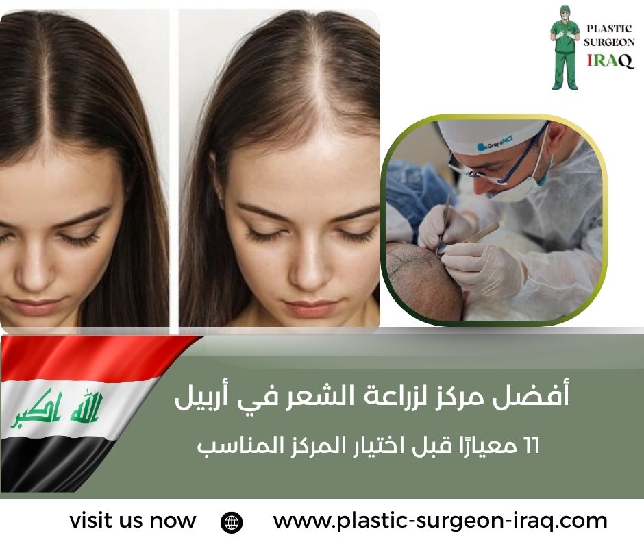 أفضل مركز لزراعة الشعر في أربيل