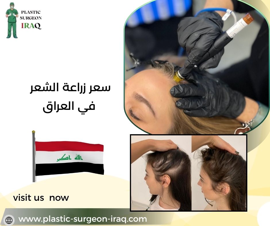 سعر زراعة الشعر في العراق