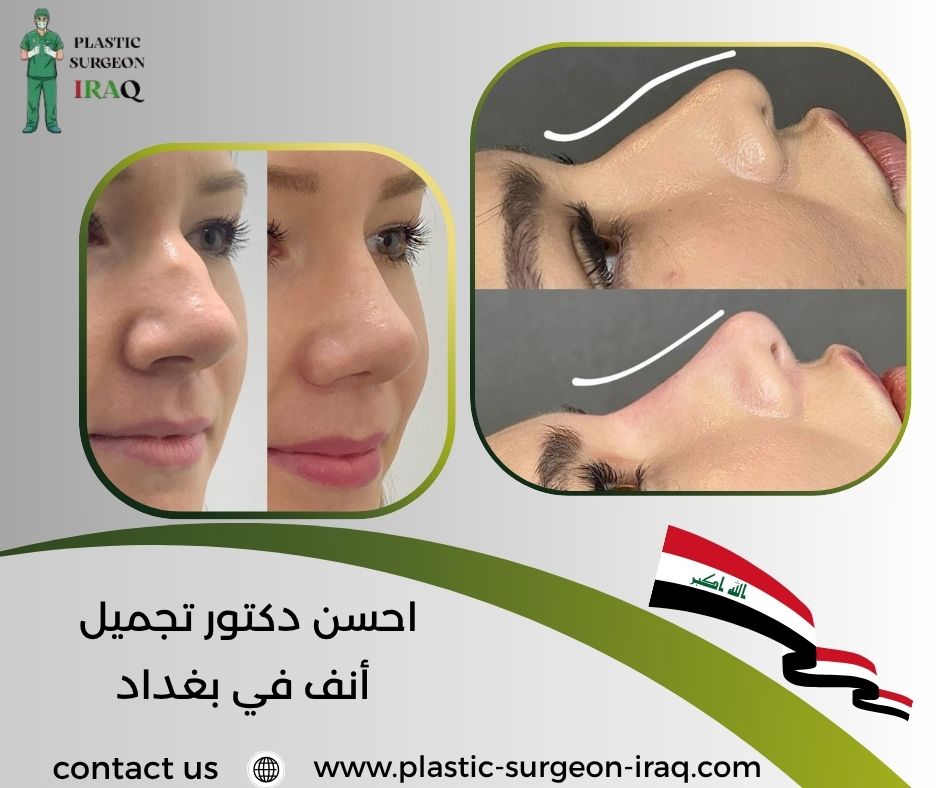 احسن دكتور تجميل أنف في بغداد