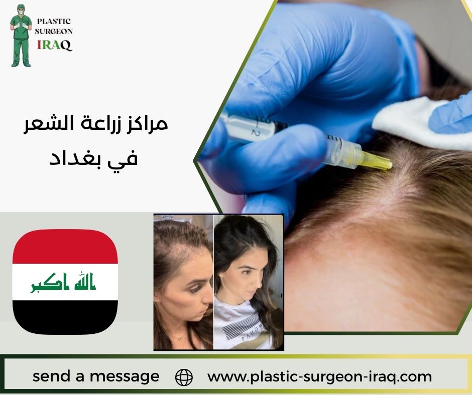 مراكز زراعة الشعر في بغداد