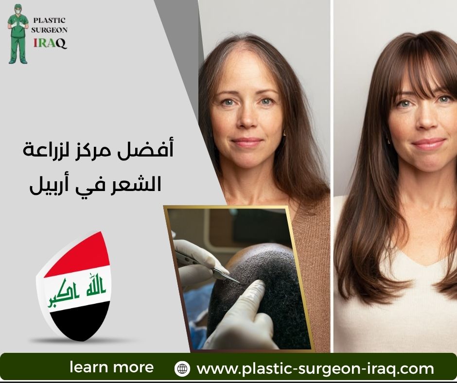 أفضل مركز لزراعة الشعر في أربيل