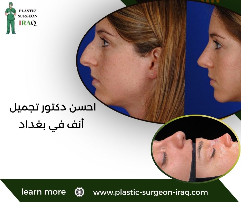احسن دكتور تجميل أنف في بغداد