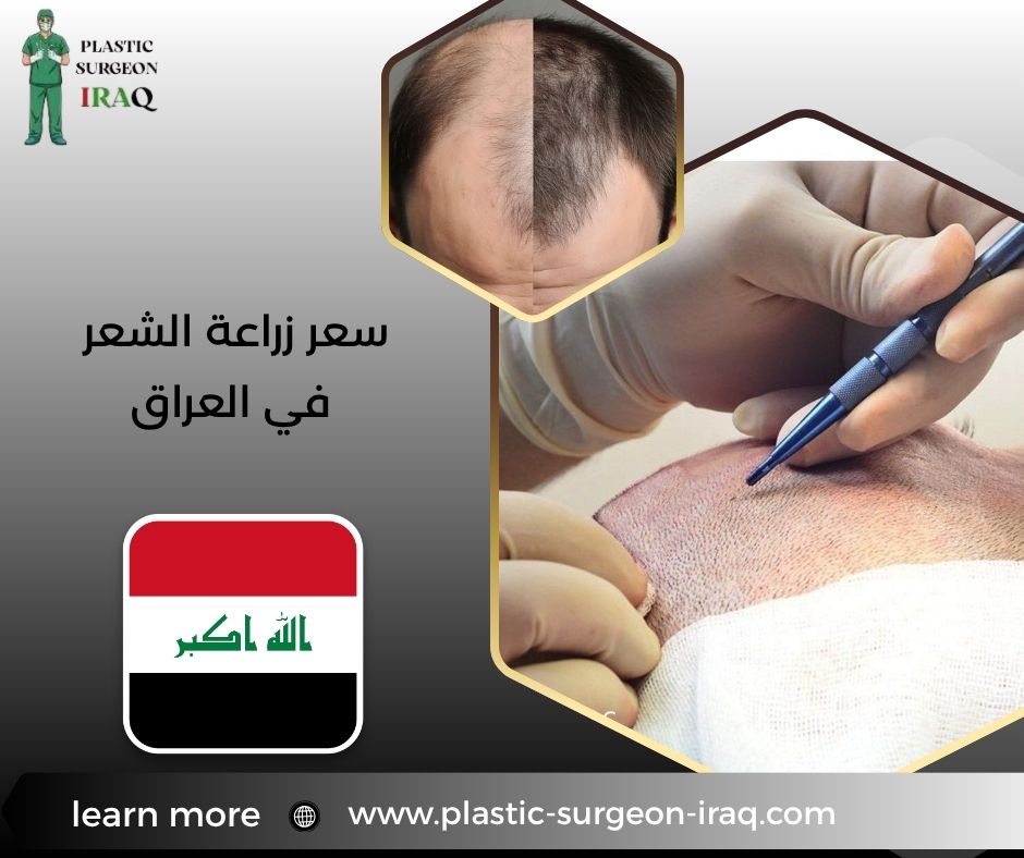 سعر زراعة الشعر في العراق
